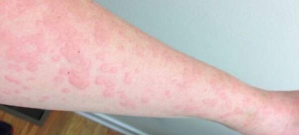 Kožní alergie jsou známkou přítomnosti parazitů v těle